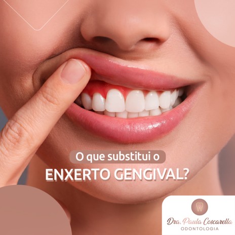 O que substitui o enxerto gengival?