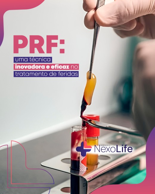 PRF: uma técnica inovadora e eficaz no tratamento de feridas