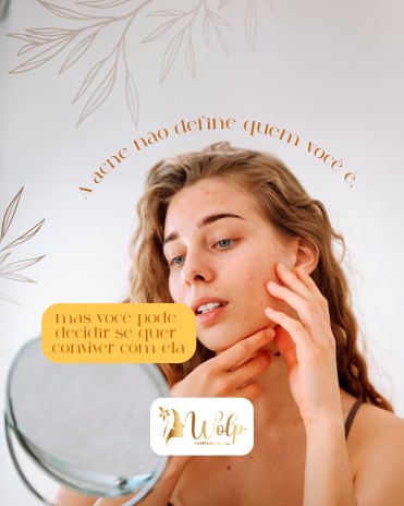 A acne não define quem você é, mas você pode decidir se quer conviver com ela
