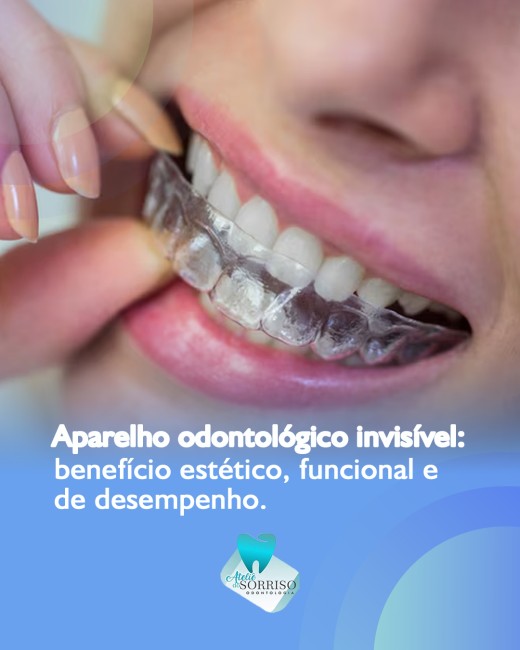 Aparelho odontológico invisível: benefício estético, funcional e de desempenho