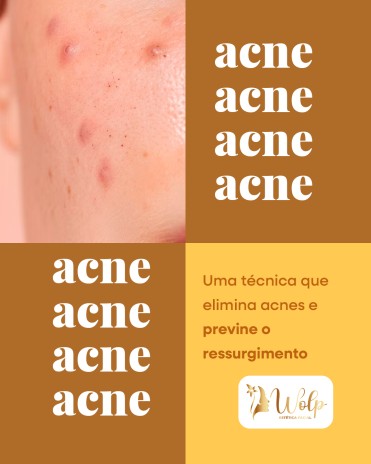 Uma técnica que elimina acnes e previne o ressurgimento