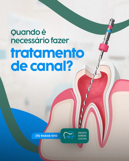 Quando é necessário fazer tratamento de canal?