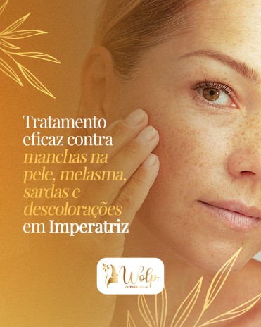 Tratamento eficaz contra manchas na pele, melasma, sardas e descolorações em Imperatriz