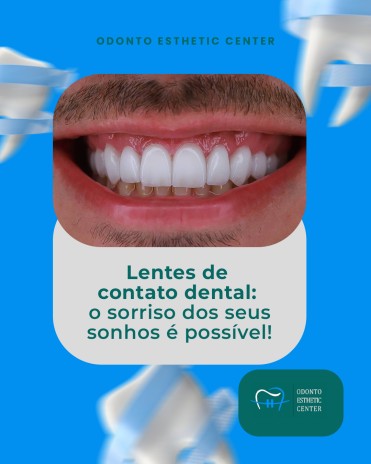 Lentes de contato dental: o sorriso dos seus sonhos é possível!