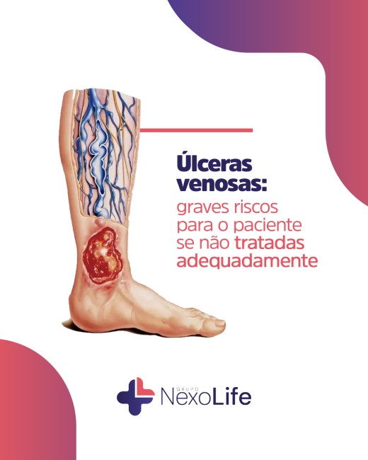 Úlceras venosas: graves riscos para o paciente se não tratadas adequadamente