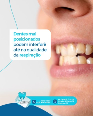Dentes mal posicionados podem interferir até na qualidade da respiração