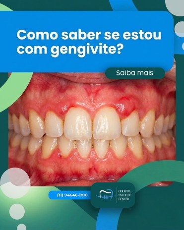 Como saber se estou com gengivite?